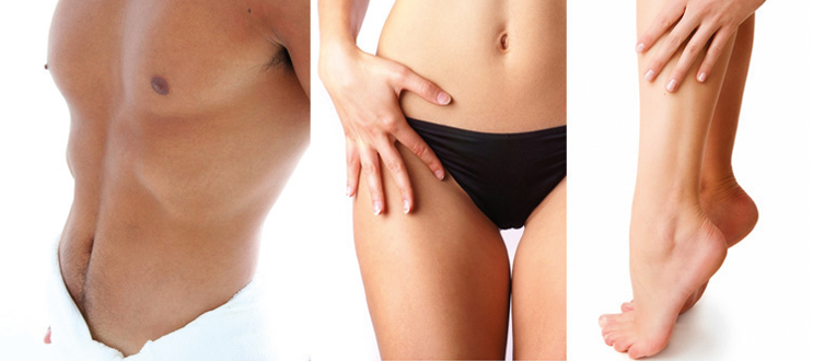 permanente laserontharing